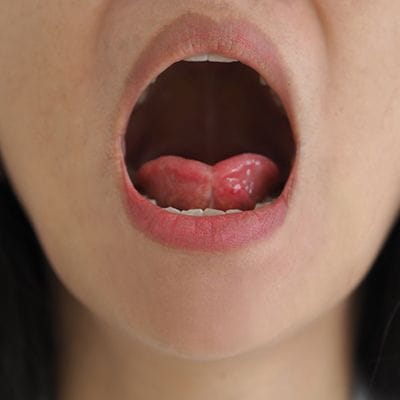 Closeup of child in need of frenectomy for lip and tongue tie