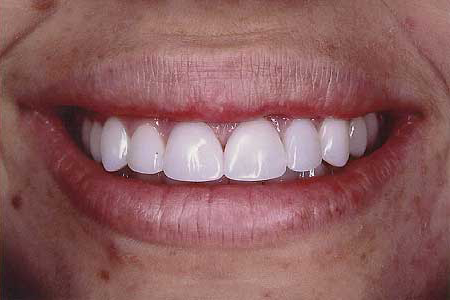 Bright white naturally shaped front teeth after composite resin veneers