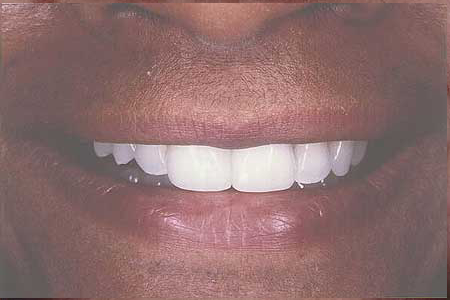 Composite veneers closing gap between front teeth