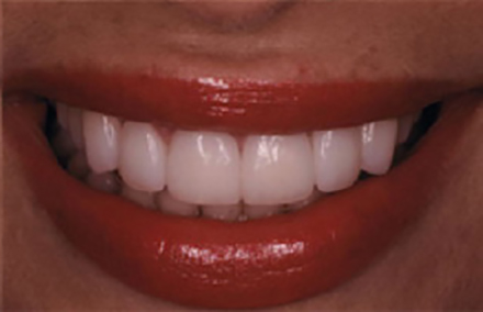 Flawlessly corrected smile with Empress veneers