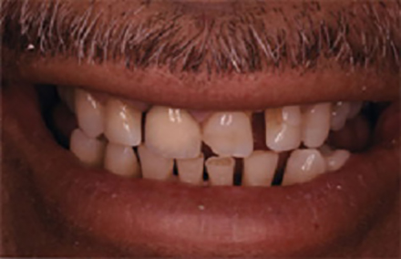 Malformed teeth with large gaps