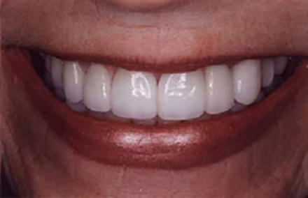 Repaired smile with Empress one and two crowns on front teeth