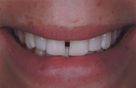 White smile with gap between front teeth