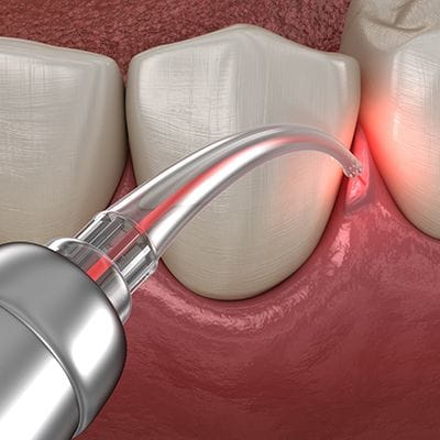 Animated laser periodontal therapy