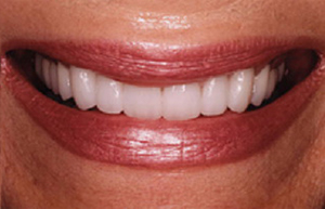 BBright white smile with Empress veneers and porcelain to gold restorations