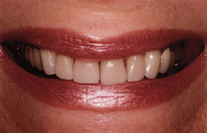 Woman's yellowed teeth with stains at gums