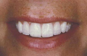 Crooked smile enhanced with all all porcelain Empress veneers