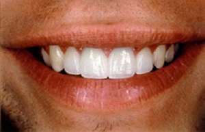 Same man's smile repaired with crowns and veneers
