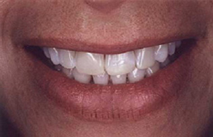 Woman's smile with discolored fillings and teeth