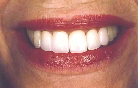 Perfectly repaired front teeth with natural looking dental crowns