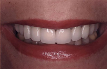 Transformed woman's smile with cosmetic porcelain-to-gold crowns