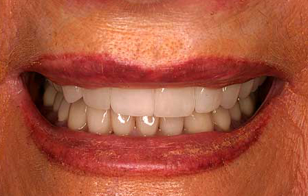 Teeth flawlessly repaired with Empress veneers and zirconia crowns