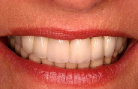 Natural looking white toothed upper denture and porcelain to gold bridge