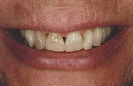 Woman's teeth thinning to gaps at gums