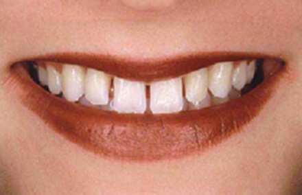 Woman's smile with large gaps between teeth