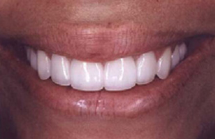 Woman after twelve tooth makeover with Empress veneers and dental crown restorations