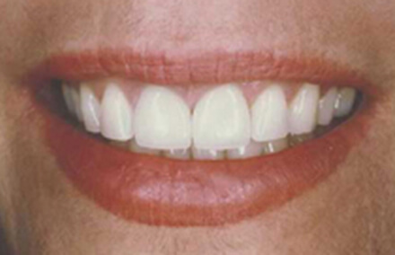 Woman's teeth corrected after Empress porcelain restoration makeover