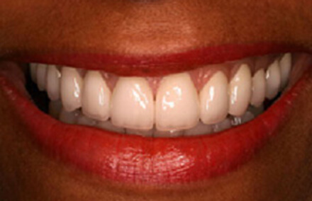Woman's smile corrected with all-porcelain crowns