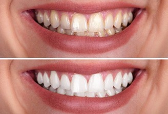Woman’s smile before and after teeth whitening