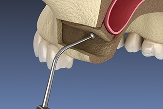 Illustration of sinus lift