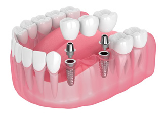 Implant bridge