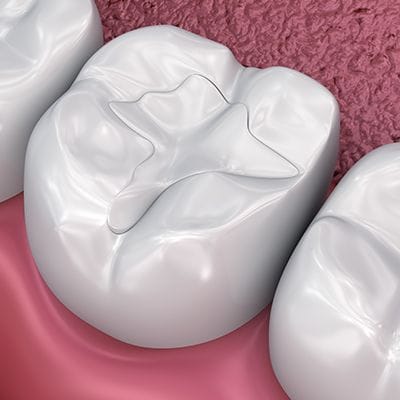 Animated teeth with dental sealants