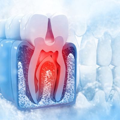 Animated tooth in need of pulp therapy