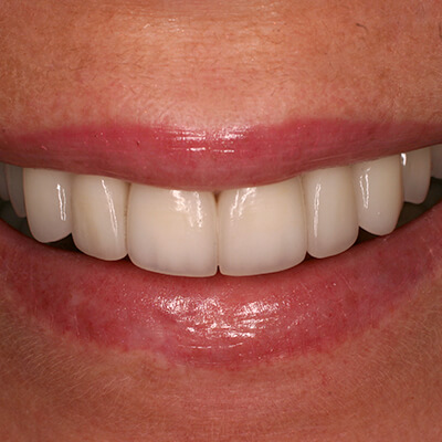 Closeup of smile after porcelain veneers