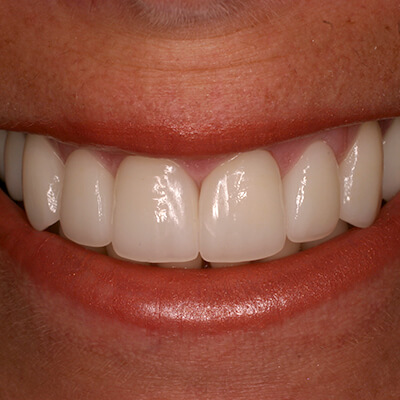 Closeup of smile with metal free dental restoration