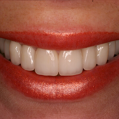 Smile after dental bonding