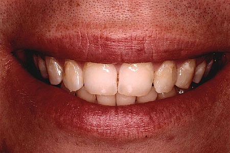 Smile flawlessly restored with tooth-colored composite onlays