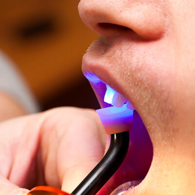 Light being shined on a tooth