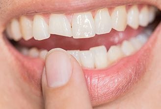 Closeup of smile with chipped front tooth