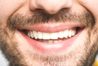 Close-up of bearded man’s smile with dental implants San Marcos, CA