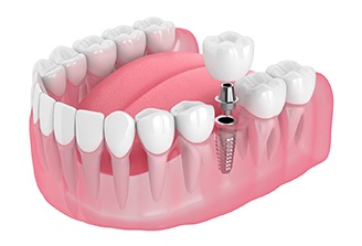 diagram showing the parts of dental implants in San Marcos