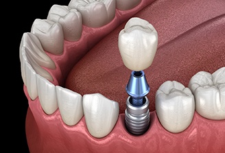 a computer illustration of an implant crown