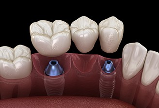 a computer illustration of an implant bridge