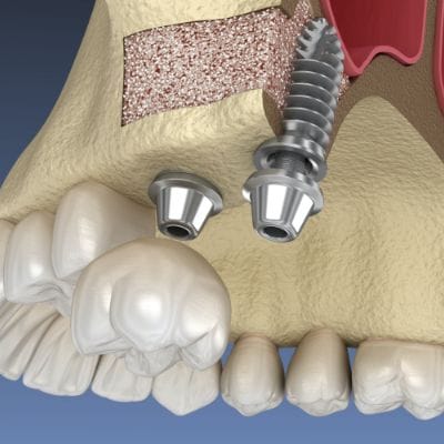 Animated dental implant supported dental crown