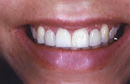 Smile with uneven gum line