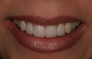 Woman's discolored teeth enhanced with veneers and porcelain to gold restorations
