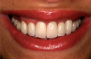 Beautiful smile following zirconia restoration