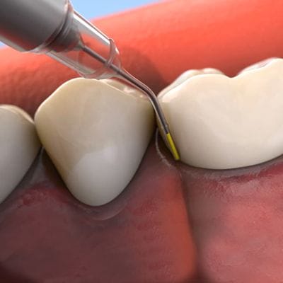 Animated Arestin antibiotic periodontal therapy process