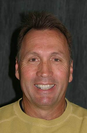 Man smiling with varied tooth coloring