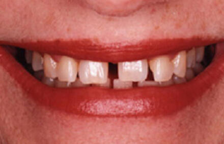 Smile with large gaps between teeth