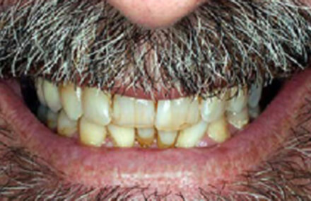 Decayed and discolored smile with tartar buildup
