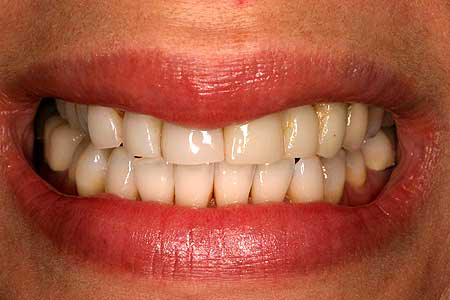 Yellowed smile with dark staining between teeth