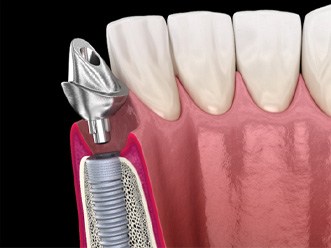 A 3D illustration of a dental implant abutment