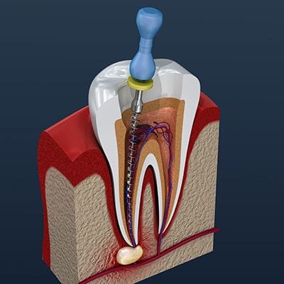 Animated root canal therapy process