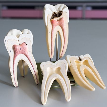 Models of the inside of teeth at various parts of root canal therapy