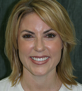 Woman with healthy smile after restorative dentistry